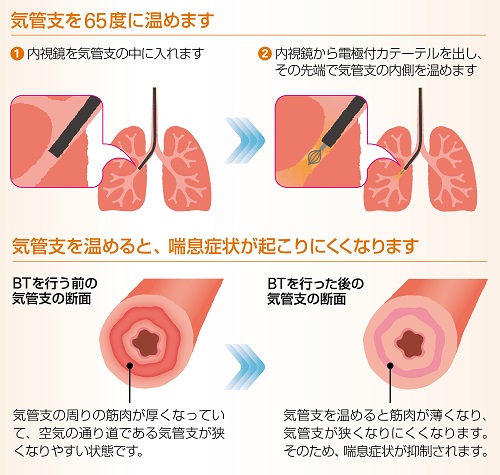 BT イメージ_W500