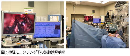 神経モニタリング下の脳動脈瘤手術