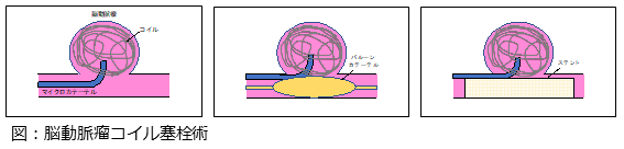 脳動脈瘤コイル塞栓術