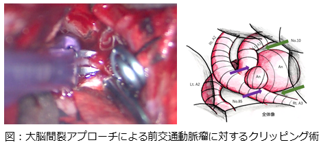 大脳間裂アプローチ