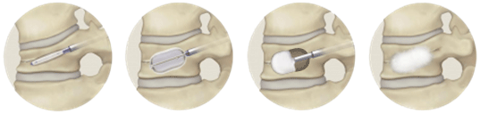 spinal_surgery02