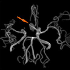 頸部MRA20mm大の巨大脳動脈瘤