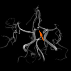 頸部MRA2mm大の脳動脈瘤