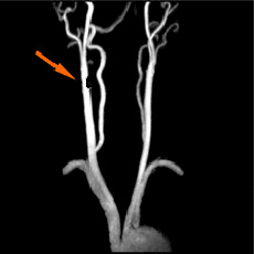 頸部MRA右内頸動脈50%狭窄